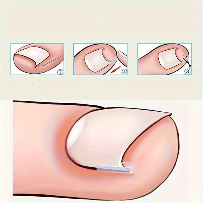 10/20/60Pcs Unscented Ingrown Toenail Strips, Brace Ingrown Toenail, Pedicure Tool, Toenail Patch For Ingrown Toenail - Image 8